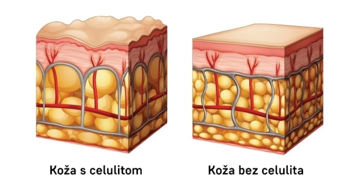 celulit4